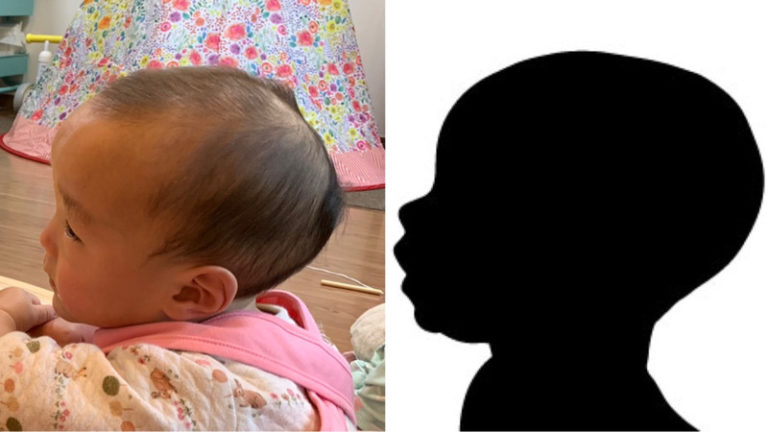ソトス症候群の特徴 長頭 後頭部と額が出ている は赤ちゃんの頃から見られます