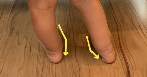 ソトス症候群の症状